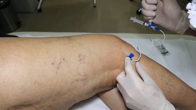 sclerotherapy склеротерапия смотреть онлайн