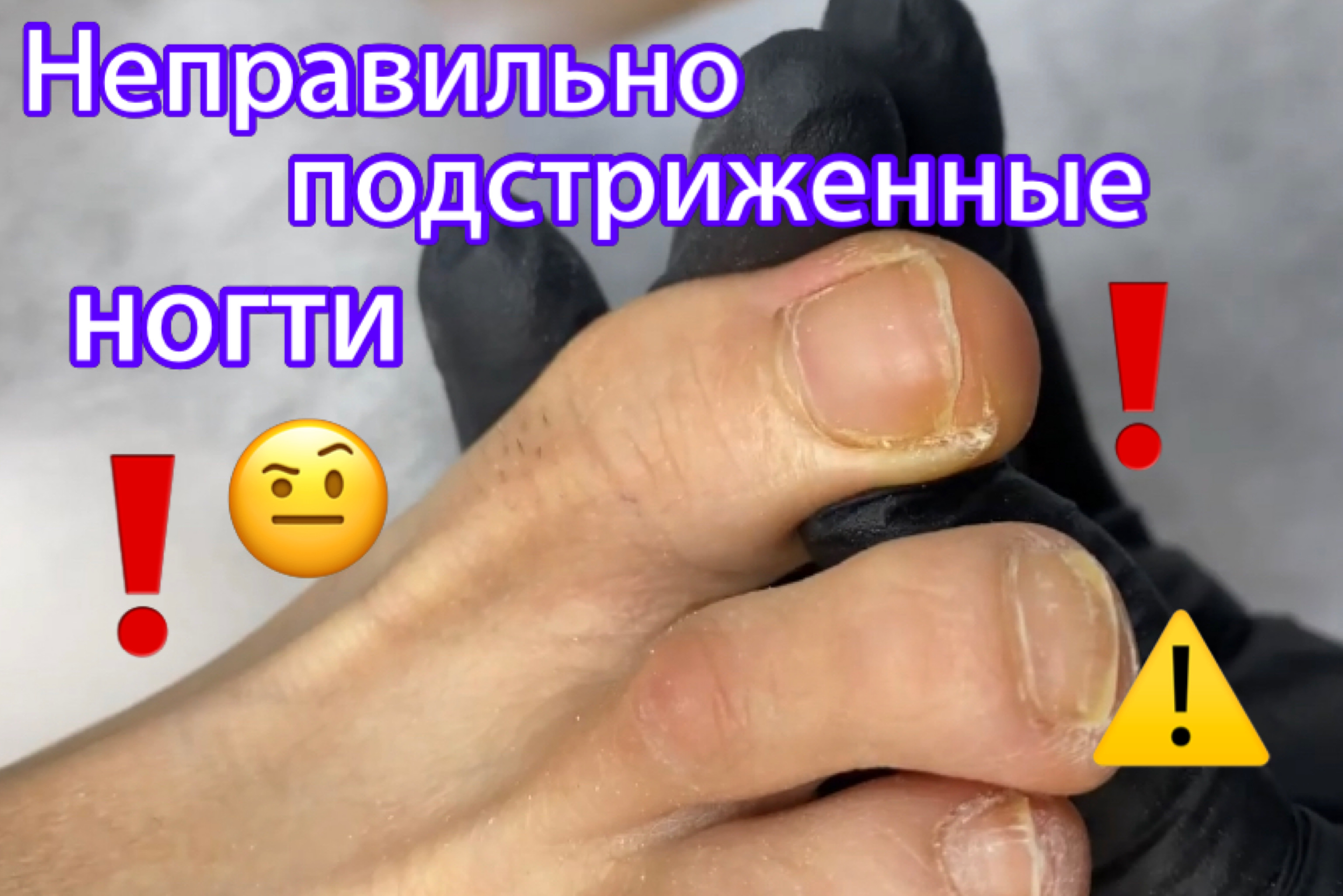Неправильно подстриженные ногти❗️⚠️?? смотреть онлайн