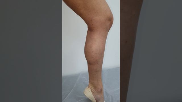 Результат операции, лечение варикоза. Флеболог Москва. Флеболог. Сосудистый хирург. Лечение вен