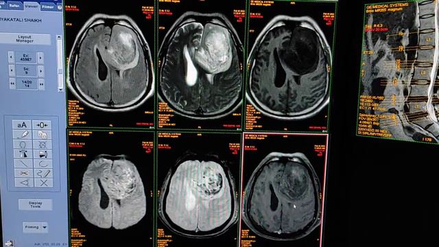 Imaging Tumors ;- High Grade Glioma (MRI Brain with Contrast). смотреть онлайн