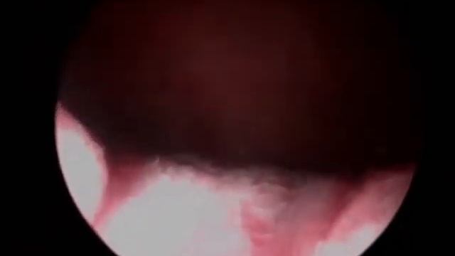 Варианты поражения слизистой при лейкоплакии мочевого пузыря смотреть онлайн