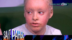 «За гранью»: «Мальчик в чешуе» | Выпуск от 25 марта 2024 года