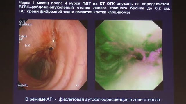 06 Легостаев ВМ Комбинированное эндоскопическое лечение рака трахеи и левого главного бронха смотреть онлайн