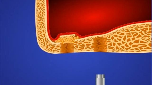 Синуслифтинг 1 закрытая методика смотреть онлайн