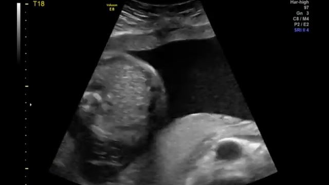 Trisomy 18 смотреть онлайн