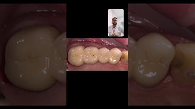 Мостовидный протез , или проще «мост» на зубы как говорят пациенты , протезирование зубов , зубы