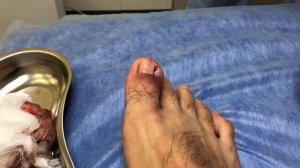 ?️ Перевязка после удаления вросшего ногтя.mp4