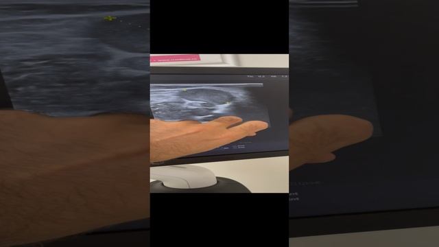 Типичный варикоз на голени. Узи сосудов. Сосудистый хирург. Флеболог Москва смотреть онлайн