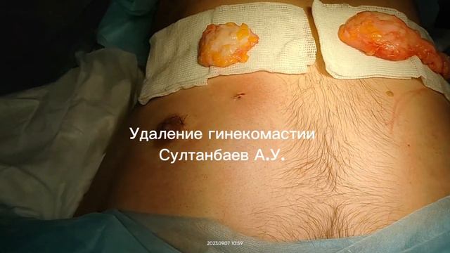 Удаление гинекомастии в Уфе смотреть онлайн