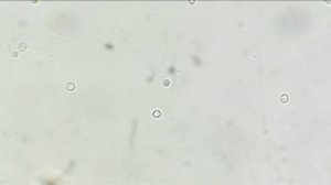 эритроциты в осадке мочи