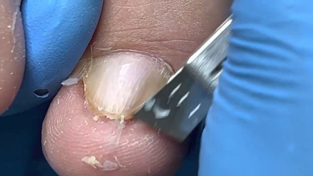 The Perfect Manicure For Nail Fungus!【Xue Yidao Pedicure】