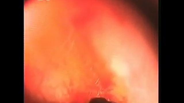 гастроскопия кошки. инородное тело 12и пер. кишки смотреть онлайн