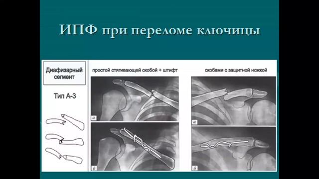 Повреждение костей пояса верхних конечностей..mp4