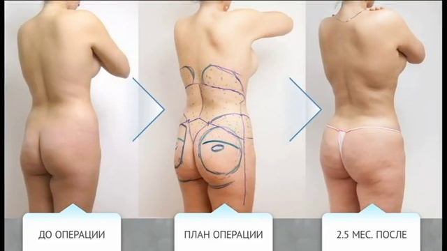 Липофиллинг ягодиц доктора Гурьянова смотреть онлайн