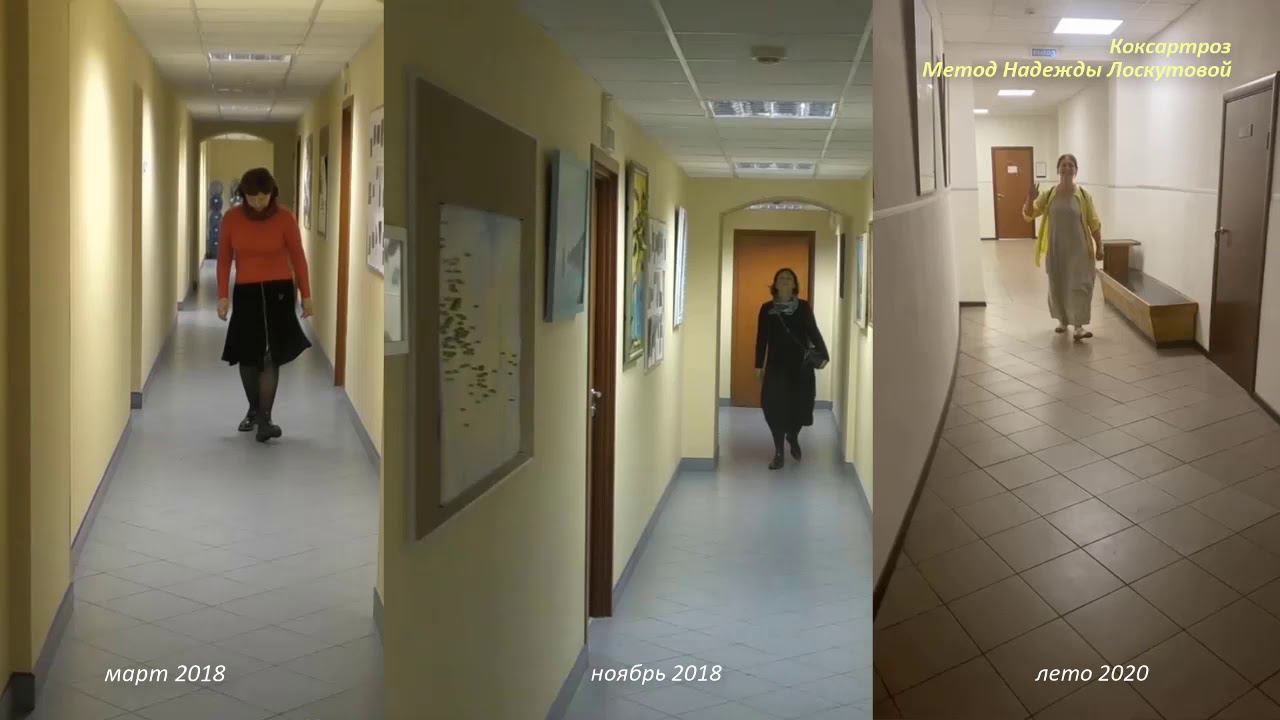 Коксартроз. Восстановление методом Лоскутовой БФМ смотреть онлайн