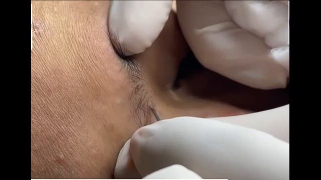 Удаление черных точек 2021 - Remoção de cera de ouvido 2022 EP01 смотреть онлайн