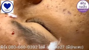 Чистка лица. Выдавливание чёрных точек. Удаление чёрных точек. Выдавливание прыщей. Лечение акне