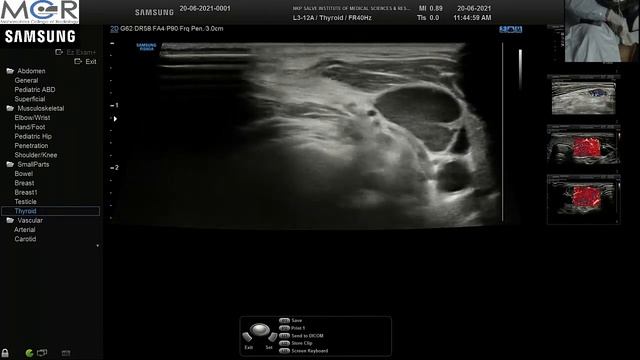 CERVICAL LYMPH NODE USG DEMO смотреть онлайн