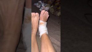 Первое упражнение после перелома лодыжки( после удвоение позиционного винта)