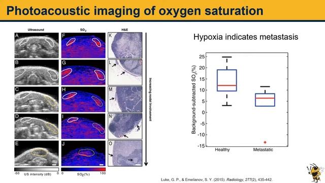 April 2018: Functional photoacoustic imaging for assessment of metastatic lymph nodes смотреть онлайн