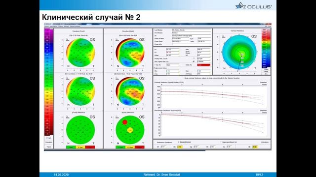 Биомеханика роговицы: новый взгляд на рефракционные вопросы – Аширматов Дармен Аскарович