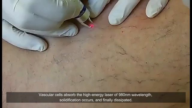 Best 980nm Diode Laser Vascular Removal Machine (2023 buyers guide) смотреть онлайн