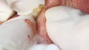 Blackhead Extraction on face, milia full.