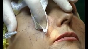 Коррекция дефицита объема щечно-скуловой области филлером Regenyal Idea. Пирамидальная техника