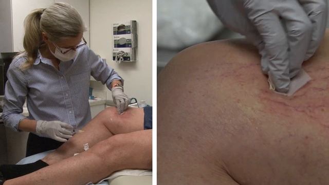 Sclerotherapy procedure for spider veins. смотреть онлайн