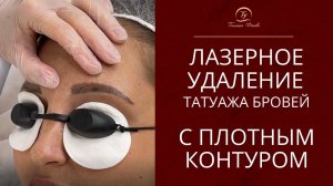 Удаление перманентного макияжа бровей лазером. Удаление плотного контура татуажа бровей.