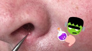 Гнойный прыщ под носом и не только. Выдавливаем угри.