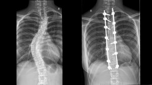 Лечение сколиоза и кифоза | Искривление позвоночника у детей