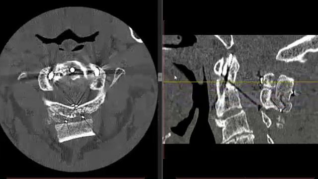 КТ (контроль) через 4 месяца после трансартикулярной фиксации С1-С2. смотреть онлайн