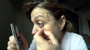 НЕ ПОВТОРЯТЬ !!! УДАЛЯЮ ЖИРОВИК НА ГЛАЗУ ИГОЛКОЙ.