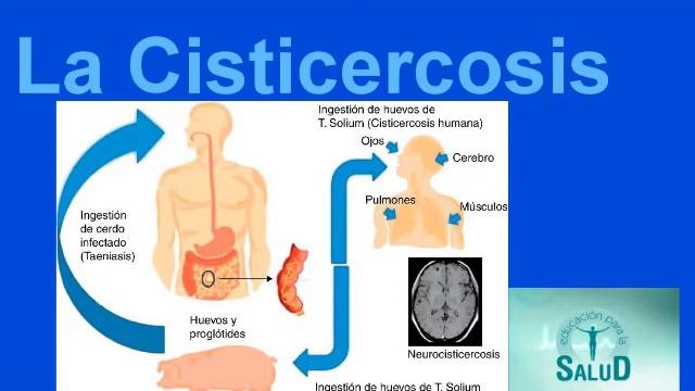 EL PELIGRO DE LA CISTICERCOSIS - Complicaciones por comer cerdo o chancho (Taenia solium) смотреть онлайн