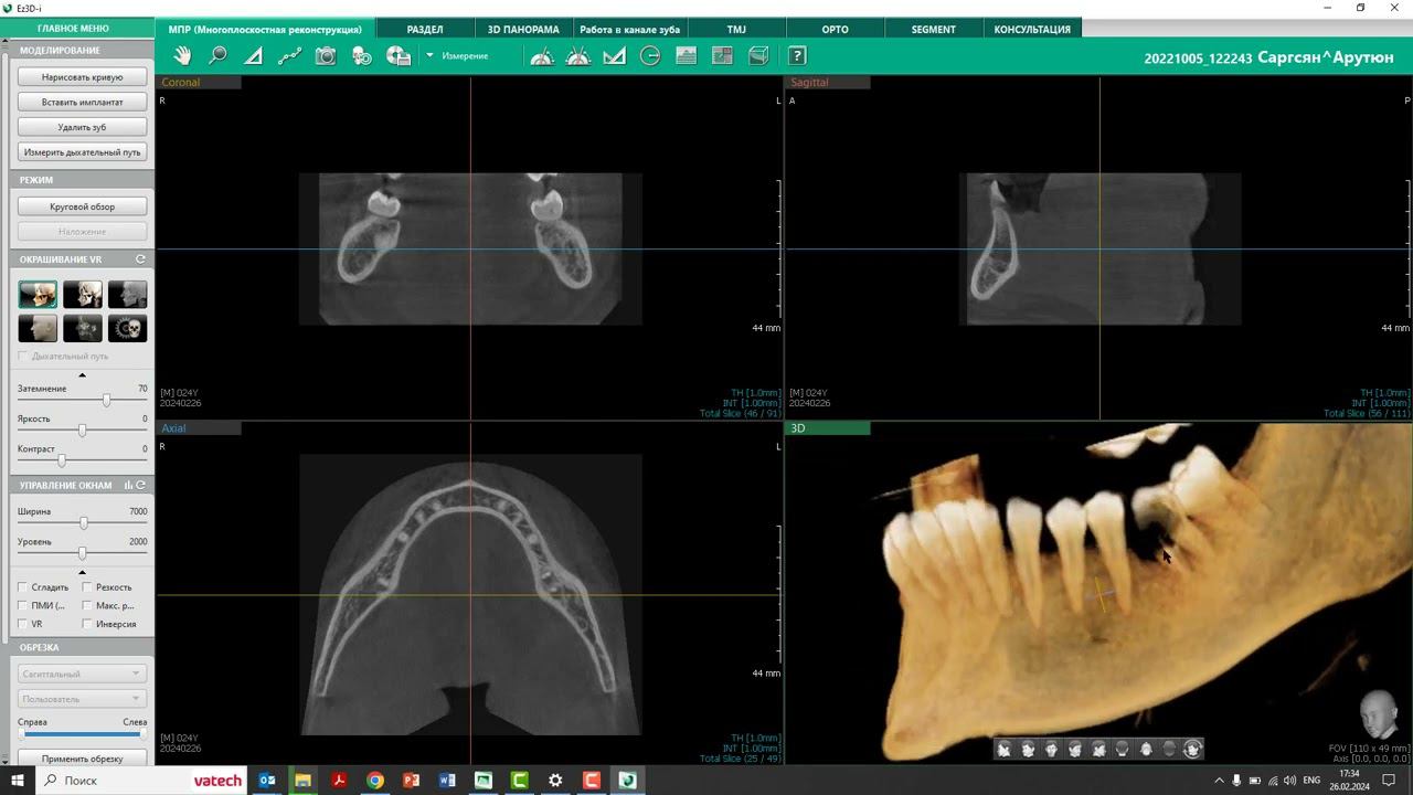 Как произвести обрезку КТ в программе Ez3D-i смотреть онлайн