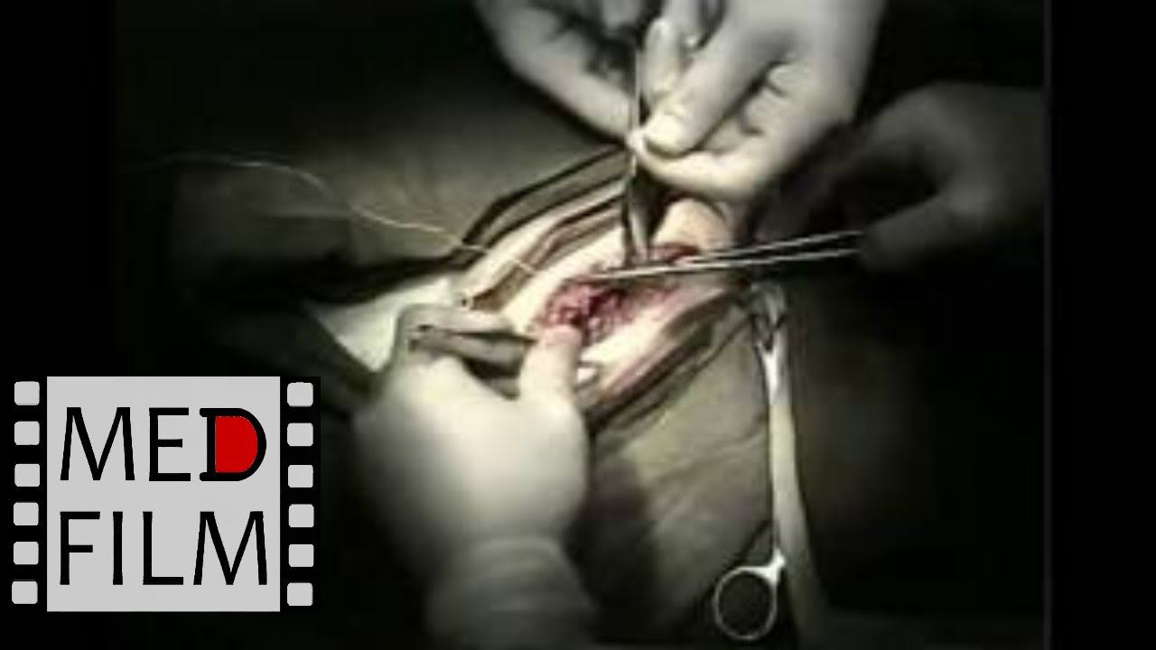 Пластика пахового канала по методу  Постемпского © Plastic inguinal canal on Postempskogo method