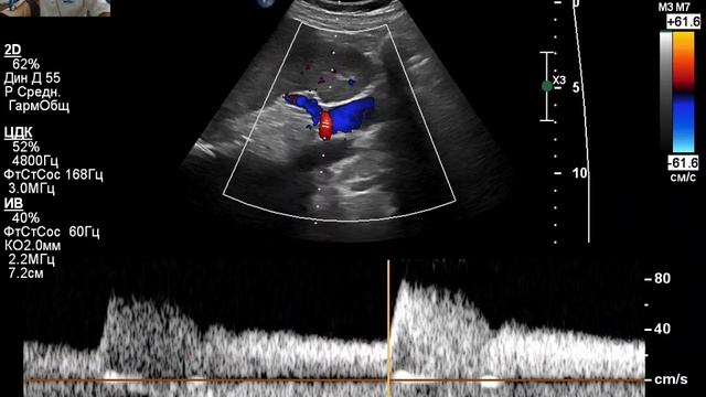 УЗИ сосудов почек. смотреть онлайн