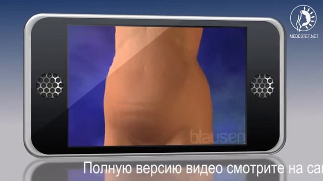 Пластика передней стенки живота смотреть онлайн