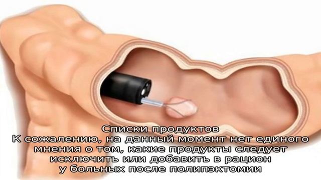 Диета после эндоскопического удаления полипов смотреть онлайн