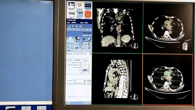 HRCT THORAX смотреть онлайн