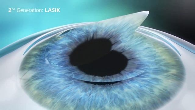Les différents types de la chirurgie réfractive au laser смотреть онлайн