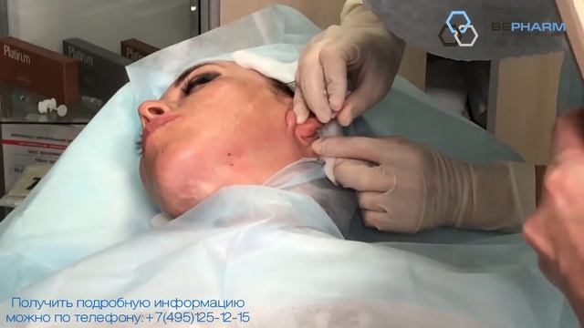 Видео мастер-класс имплантации нитей на двух иглах