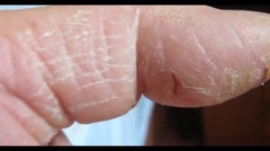 Сохнет и трескается кожа на руках