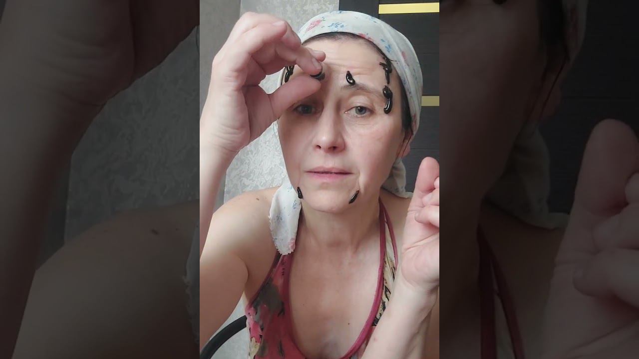 ГИРУДОКОСМЕТОЛОГИЯ смотреть онлайн