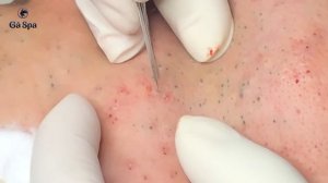 Super Blackheads Part 3 | Ga Spa| 09.02.2022