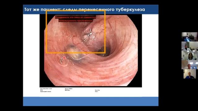 2 Сивокозов ИВ и др Игра отражений: современная диагностическая бронхоскопия высокого разрешения. смотреть онлайн