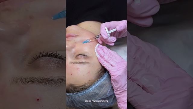 Жемчужная биоревитализация у нашего специалиста Романовой Олеси смотреть онлайн