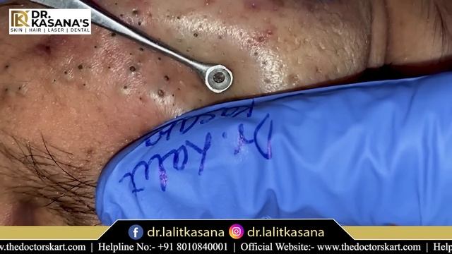 Goldmine Of Blackheads Full Video By Dr.Lalit Kasana II Blackheads Removal By Dr Lalit Kasana II