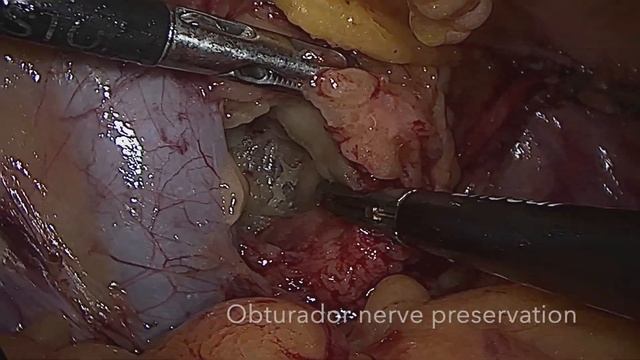 Obturator lymph node dissection смотреть онлайн